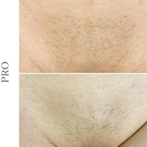 ペガサスプロ VIO脱毛 ビフォアアフター