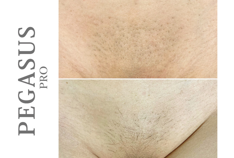 ペガサスプロ VIO脱毛 ビフォアアフター