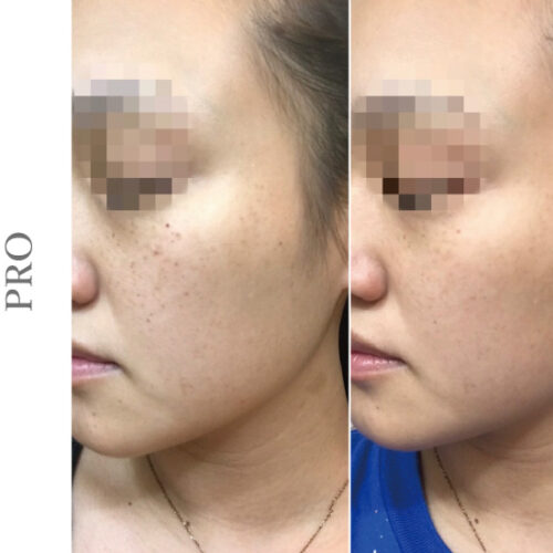 ペガサスプロ Eライトでシミ撃退