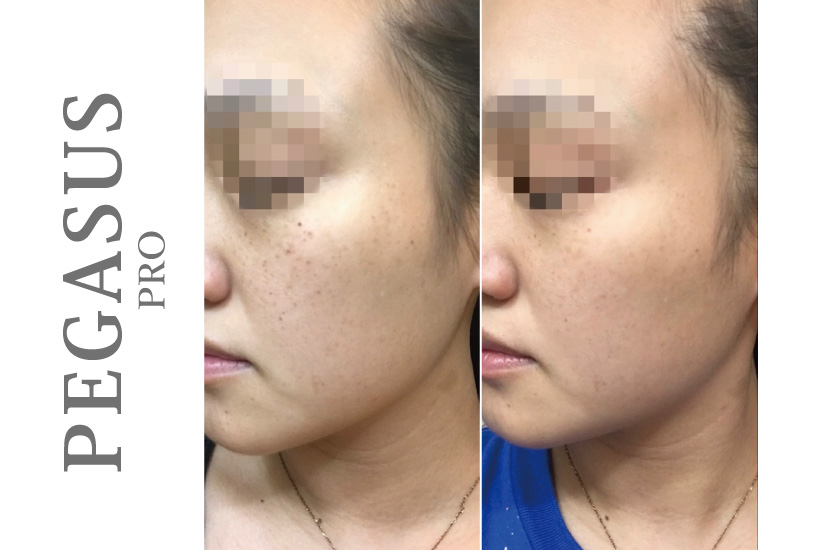 ペガサスプロ Eライトでシミ撃退