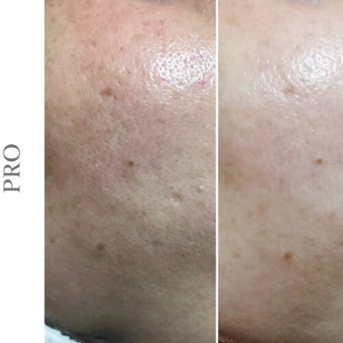 ペガサスプロ カーボンピーリング オイリー肌改善