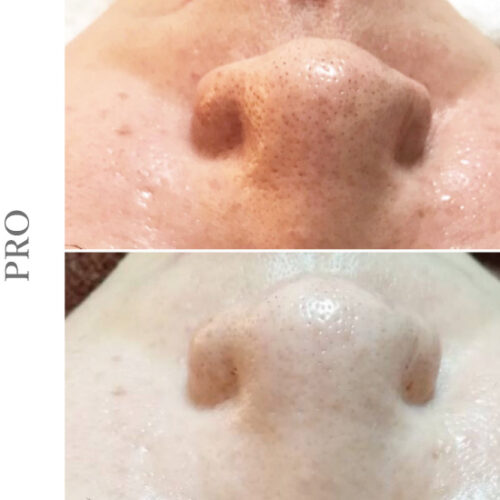 ペガサスプロ 毛穴つまり解消