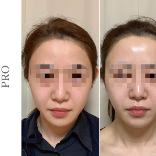 ペガサスプロ アイス高周波ビフォアアフター