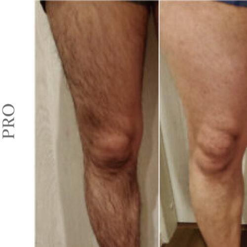 ペガサスプロ メンズ足脱毛 ビフォアアフター