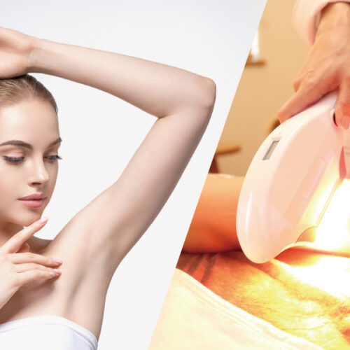 ペガサスプロ SHR高速脱毛