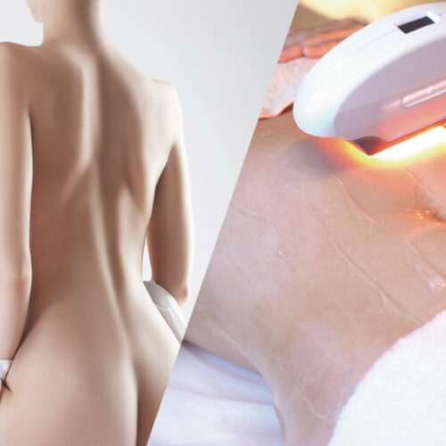 ペガサスプロ SSR 全身光美白