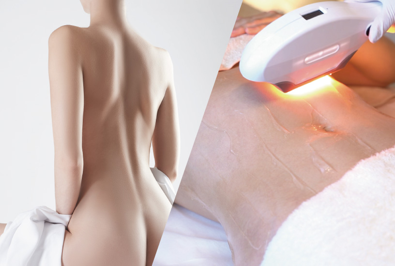 ペガサスプロ SSR 全身光美白