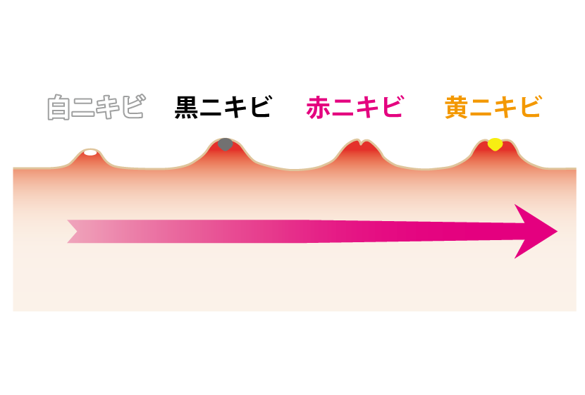 ニキビ4種類イラスト