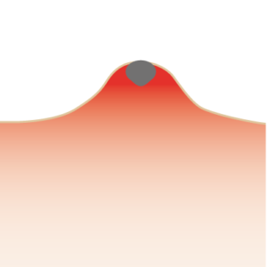 ニキビ跡-黒ニキビ