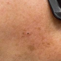 ニキビ跡の種類－色素沈着