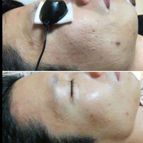 カーボンピーリングビフォアアフター